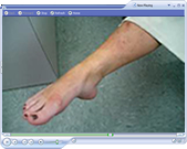 Dr. Nath - Foot Drop specialist that repairs paralysis in the muscles that  normally lift the foot.